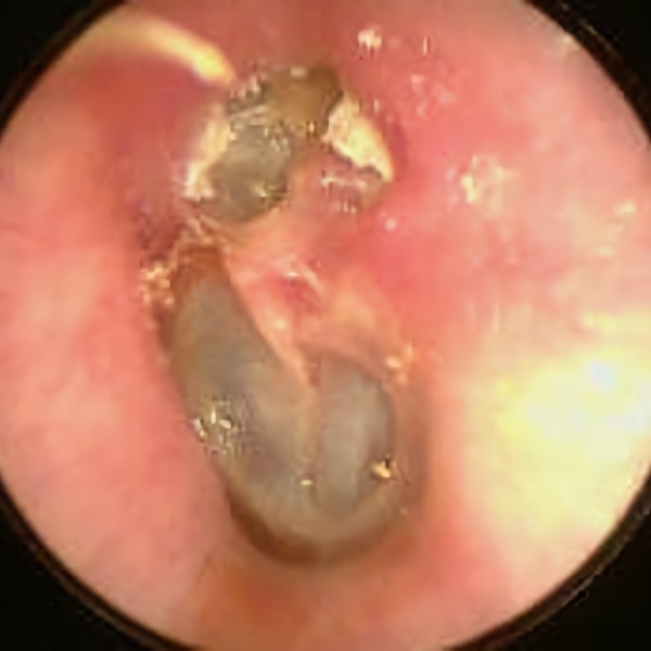 Attik Kolesteatom - Prof. Dr. Haluk Özkarakaş