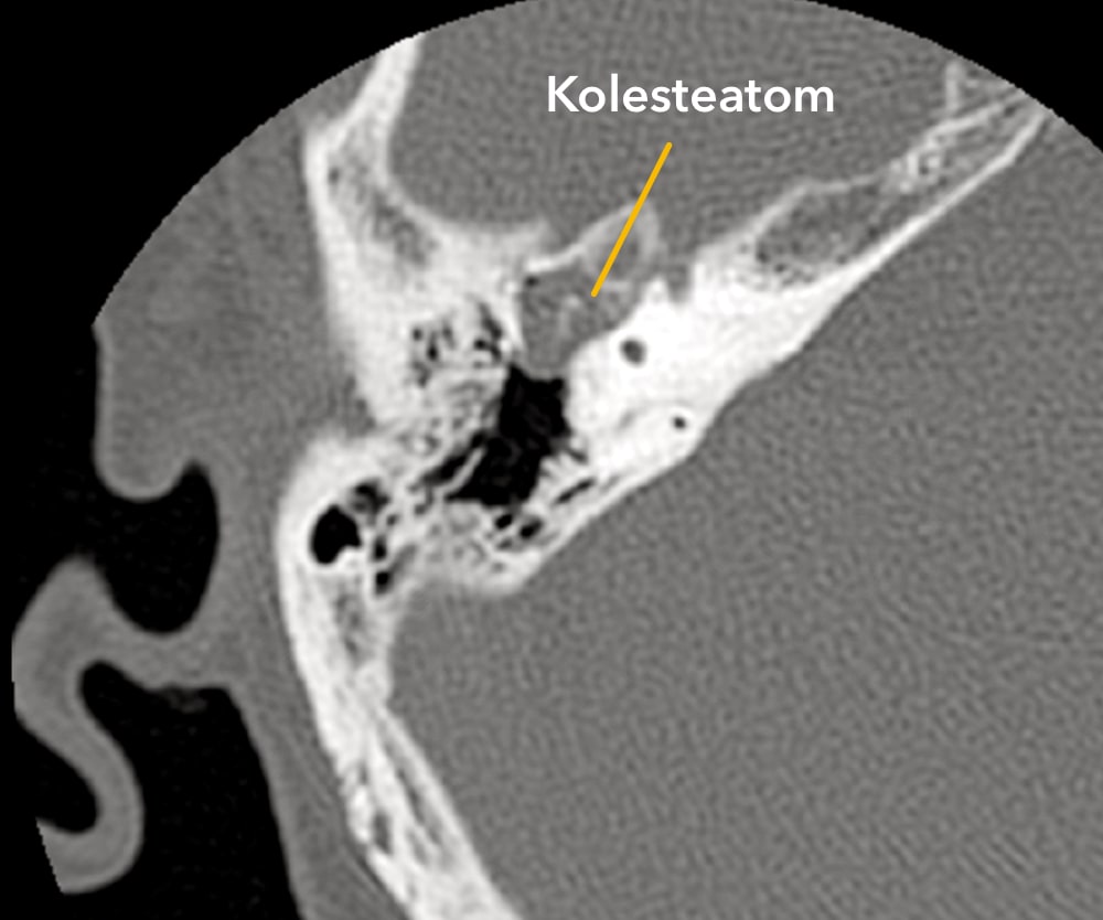 Kolesteatom - Prof. Dr. Haluk Özkarakaş