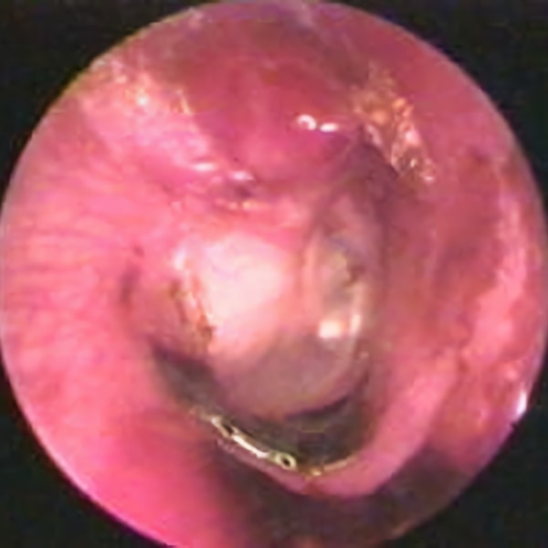 Orta Kulağı Kaplayan Kolesteatom - Prof. Dr. Haluk Özkarakaş