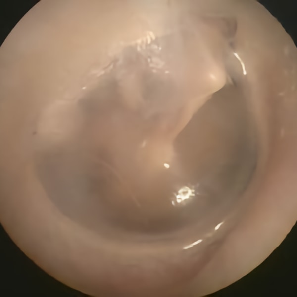 Sağlıklı Kulak Zarı - Prof. Dr. Haluk Özkarakaş